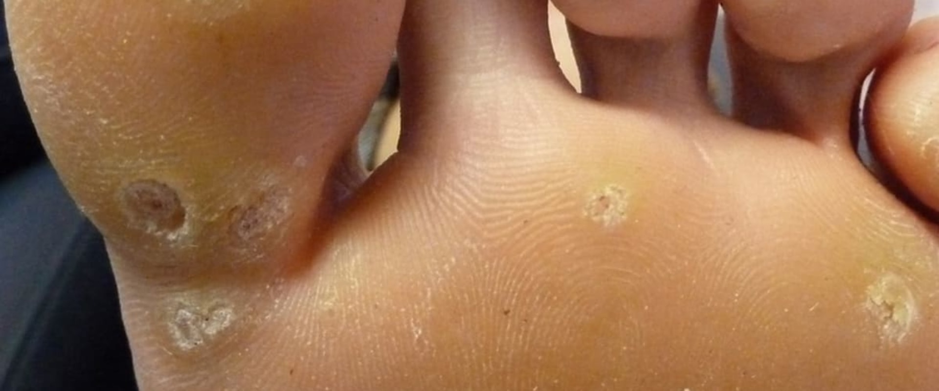 3 Symptoms of Genital Warts You Should Know About