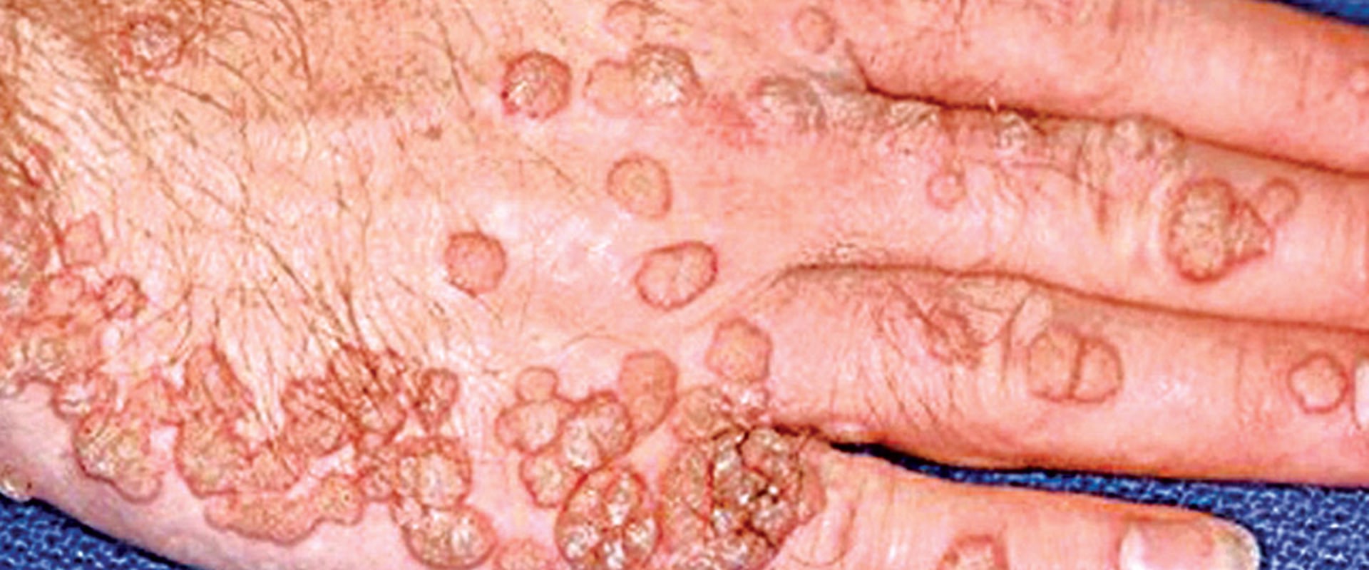 Are Genital Warts Contagious Even After They're Gone? - An Expert's Perspective