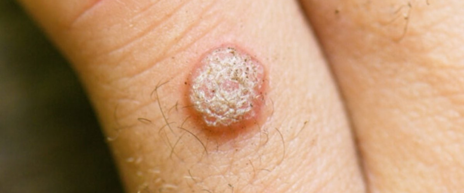 Understanding Genital Warts: Causes, Prevention, and Treatment