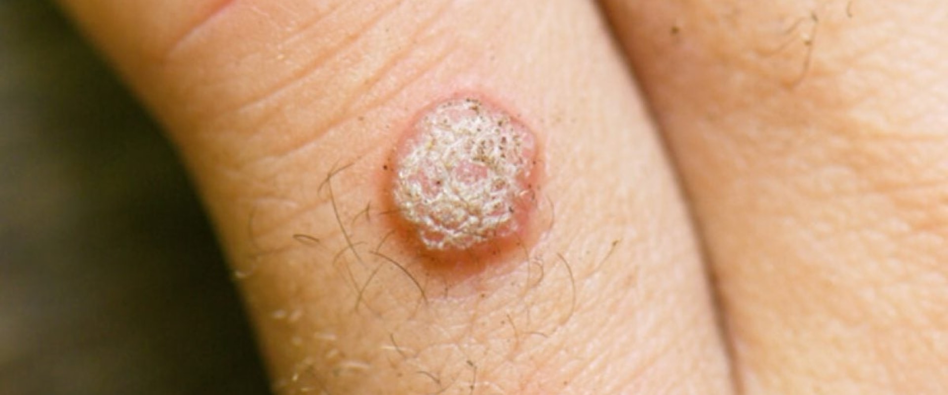 Understanding the Progression of Genital Warts: An Expert's Guide