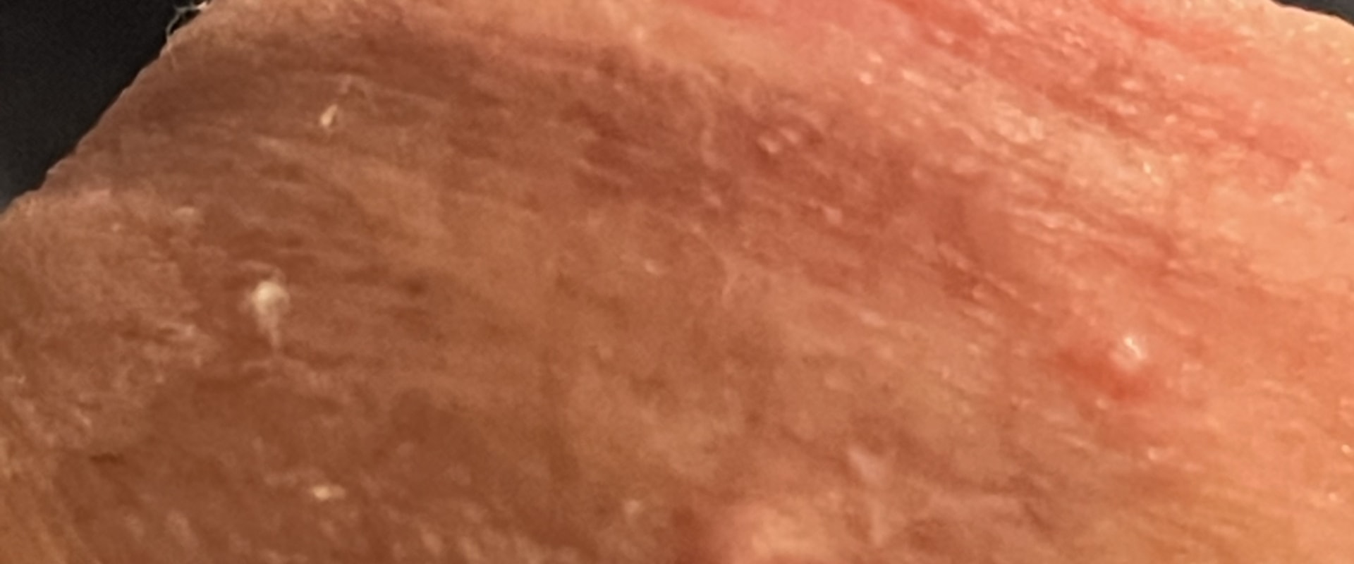 What Do Genital Warts Feel Like to the Touch?