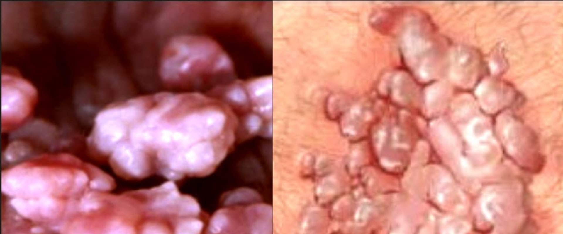 Genital Warts: Causes, Prevention, and Treatment