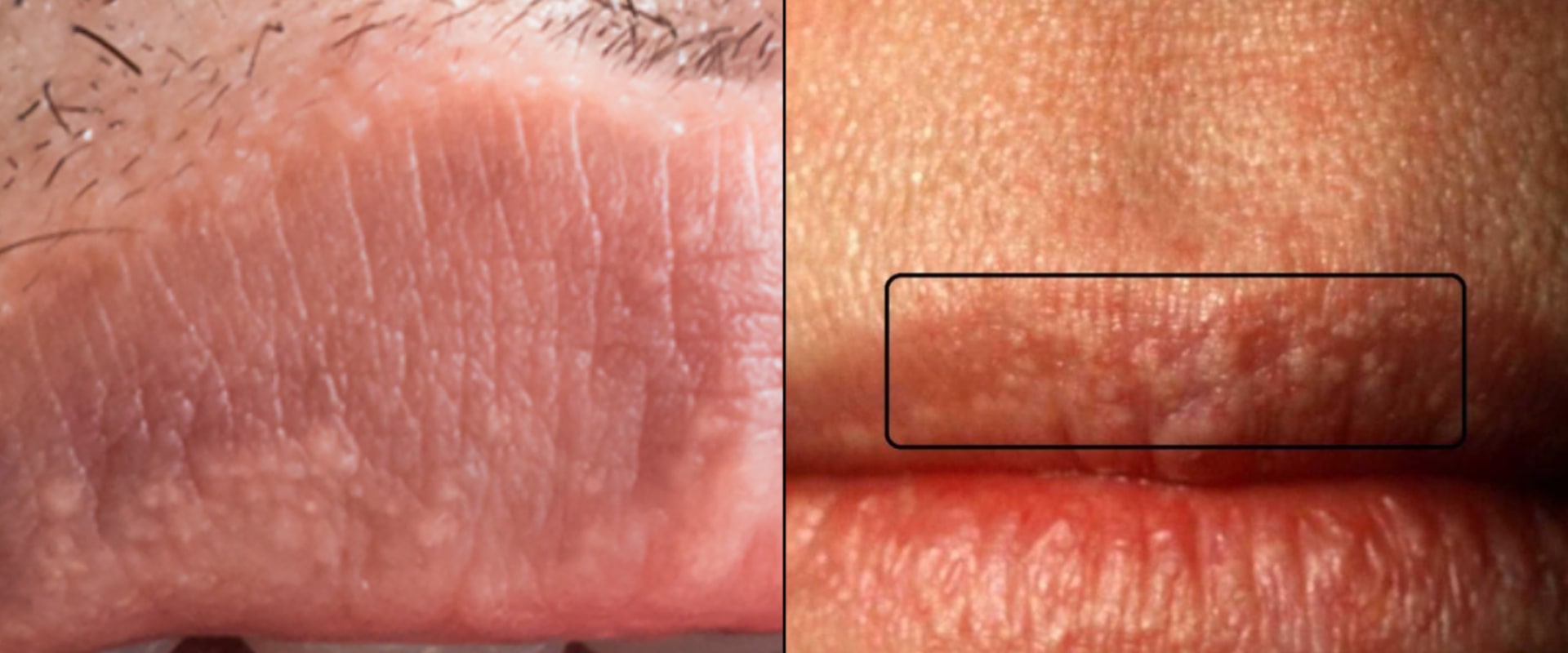 Why Do Genital Warts Turn White? A Comprehensive Guide