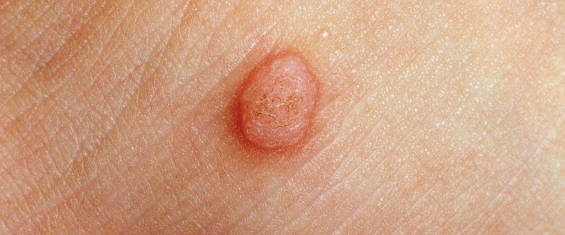 What Are Genital Warts and How Can You Treat Them?