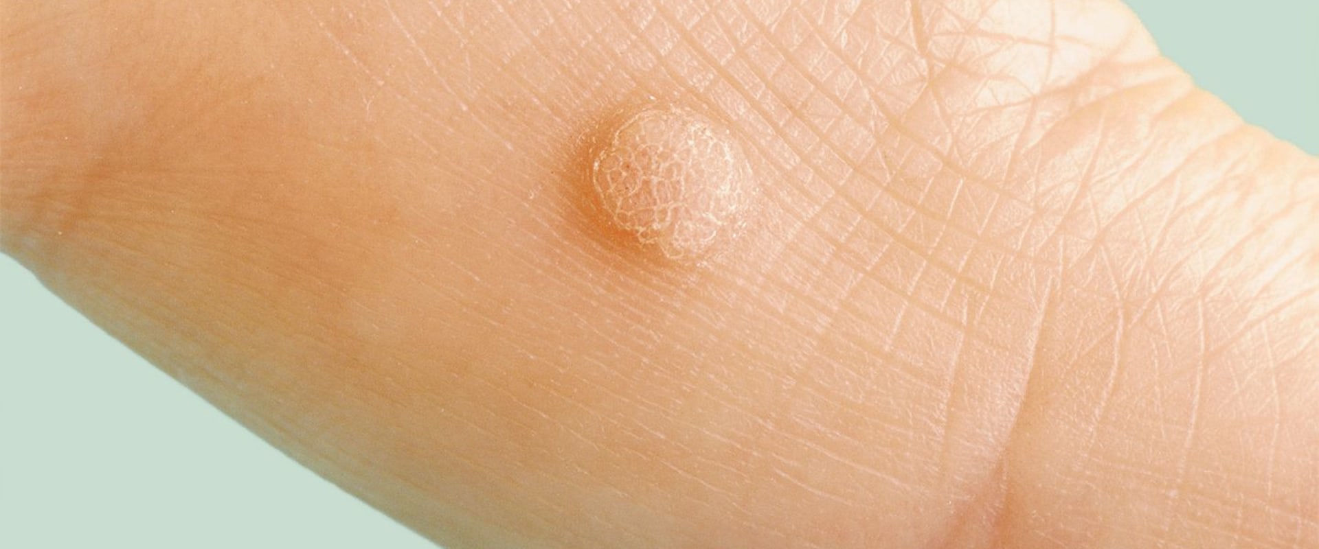 Everything You Need to Know About Genital Warts and HPV