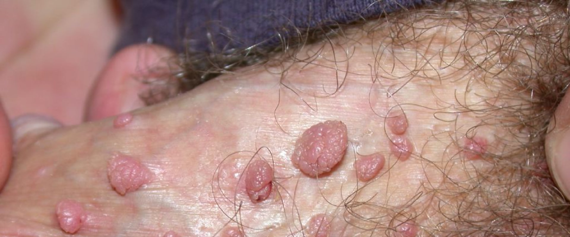 Are Genital Warts a Permanent STD?