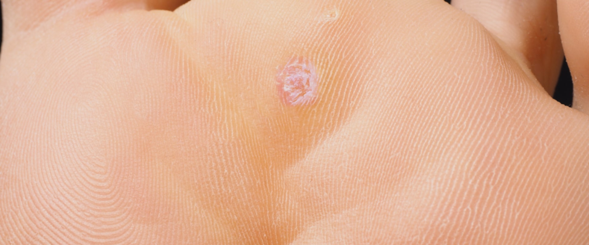 How to Prevent Genital Warts and Where They Can Spread