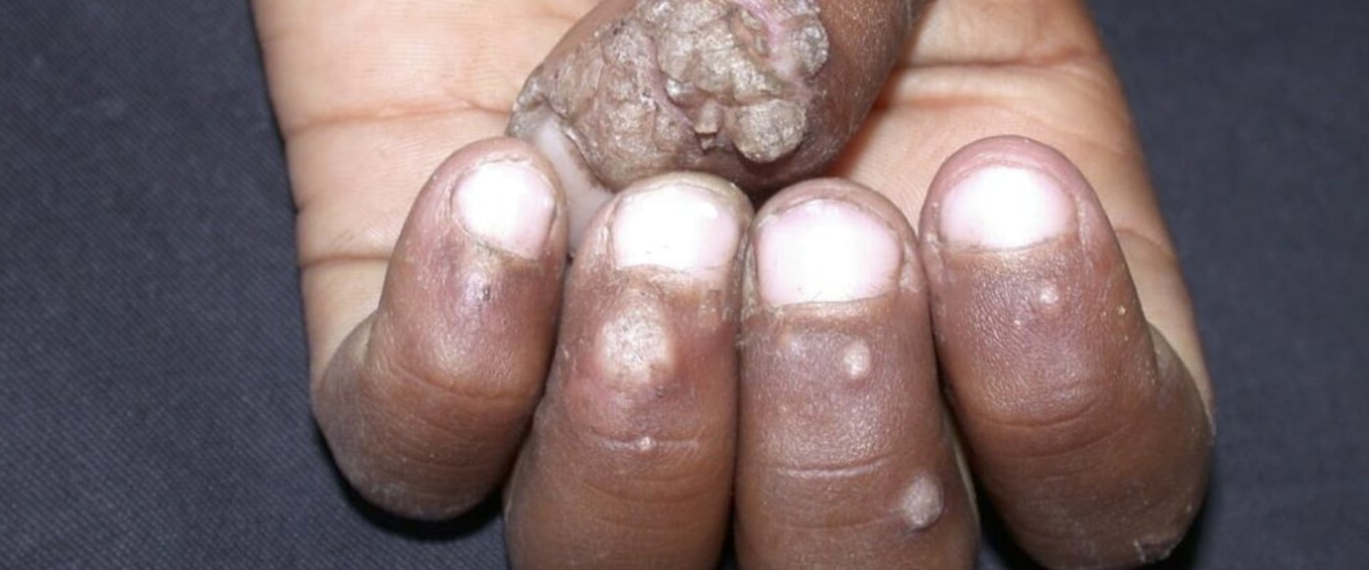 Understanding the Transmission of Genital Warts