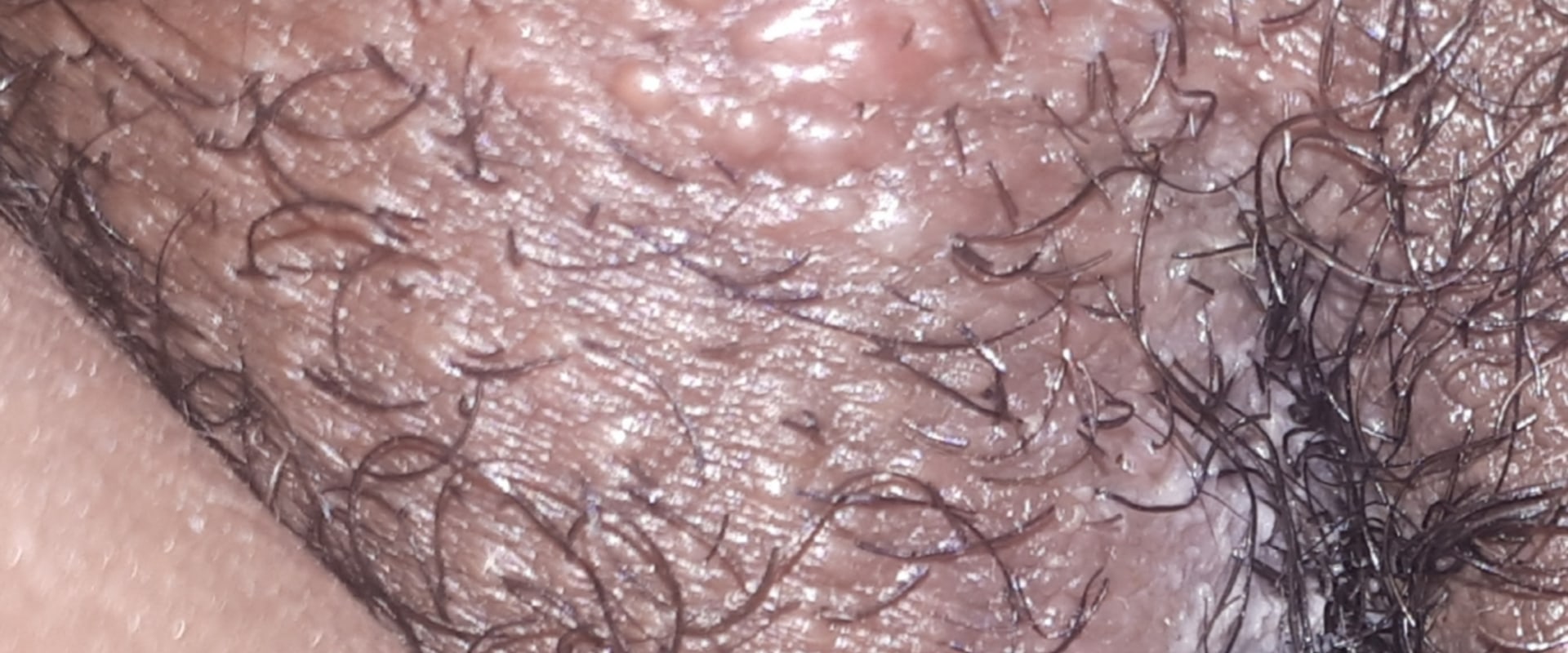 when-do-genital-warts-appear-a-comprehensive-guide-to-hpv-and-prevention