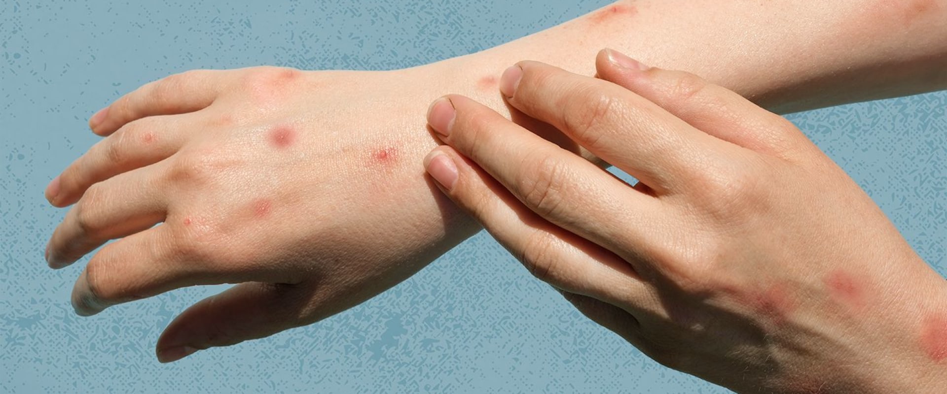 Who Gave Me Genital Warts? Understanding the Causes and Prevention of HPV