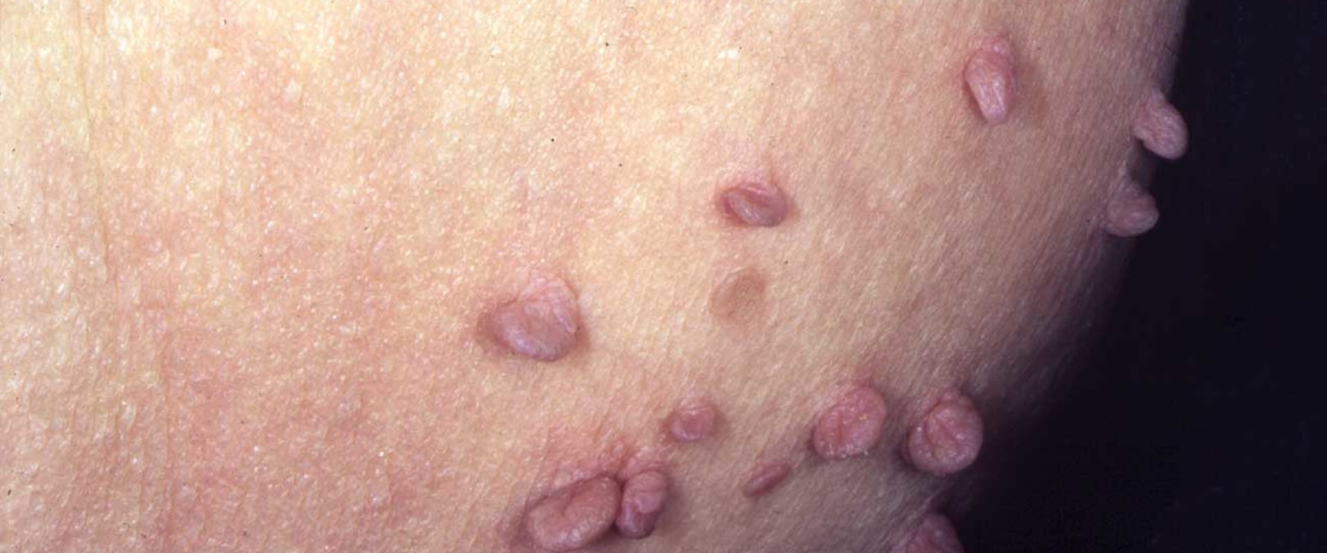 Understanding Genital Warts: Causes, Prevention and Treatment