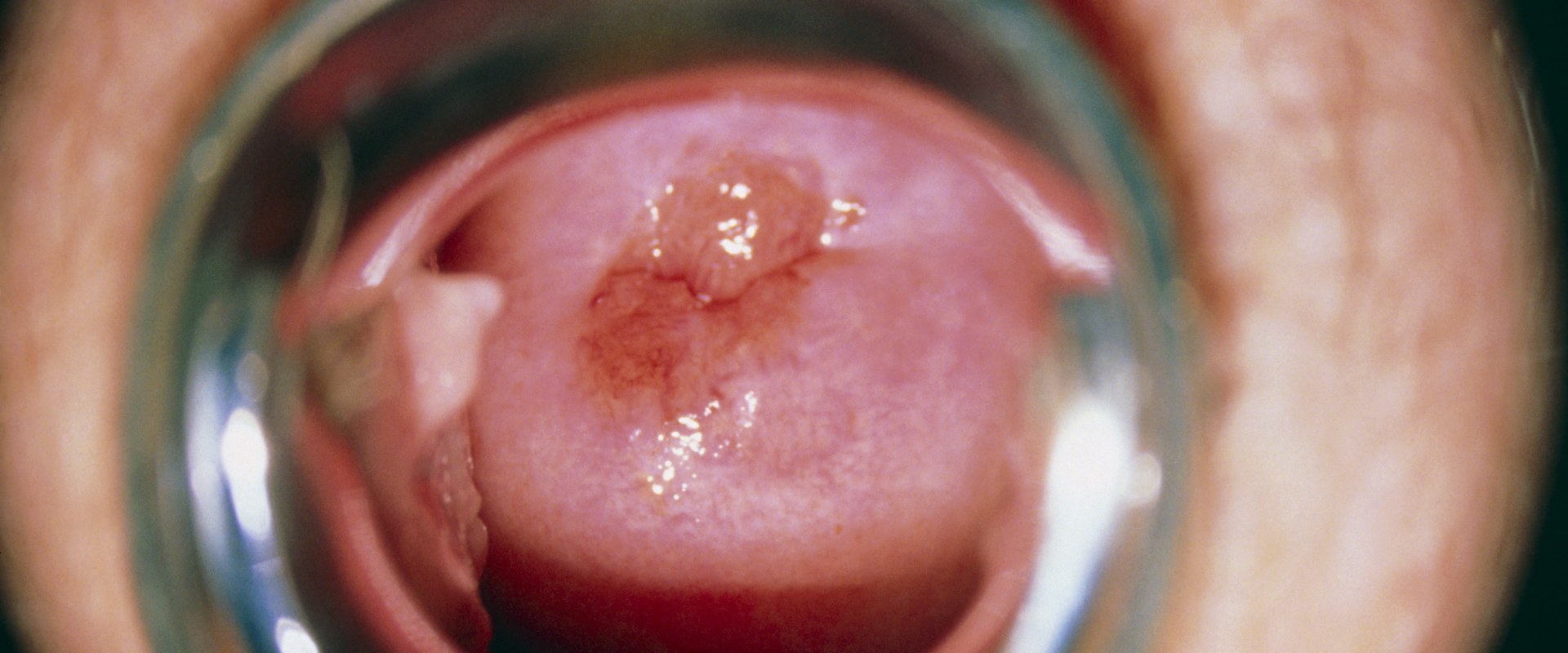 How Long Does It Take for Genital Warts to Become Cancerous?