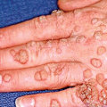Are Genital Warts Contagious Even After They're Gone? - An Expert's Perspective
