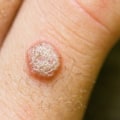 Understanding Genital Warts: Causes, Prevention, and Treatment