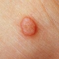 Do Genital Warts Bleed? An Expert's Guide to Understanding and Treating