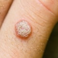 Understanding the Progression of Genital Warts: An Expert's Guide