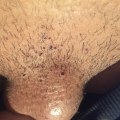 Can Genital Warts Be Black?