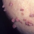 Why Genital Warts Itch and How to Treat Them