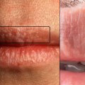 Why Do Genital Warts Turn White? A Comprehensive Guide