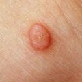 What Are Genital Warts and How Can You Treat Them?
