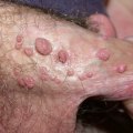 Are Genital Warts a Permanent STD?