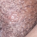 When do Genital Warts Appear? A Comprehensive Guide to HPV and Prevention