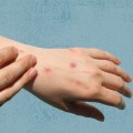 Who Gave Me Genital Warts? Understanding the Causes and Prevention of HPV
