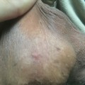 Can I Find Out Who Gave Me Genital Warts? - An Expert's Guide