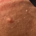 What Are the Symptoms of Genital Warts and How Can I Tell If I Have Them?