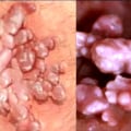 What Happens When Genital Warts Vanish?
