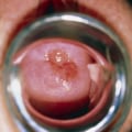 How Long Does It Take for Genital Warts to Become Cancerous?