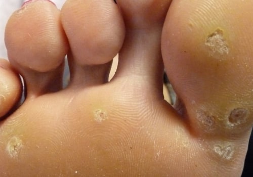 3 Symptoms of Genital Warts You Should Know About