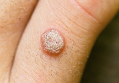 Understanding Genital Warts: Causes, Prevention, and Treatment