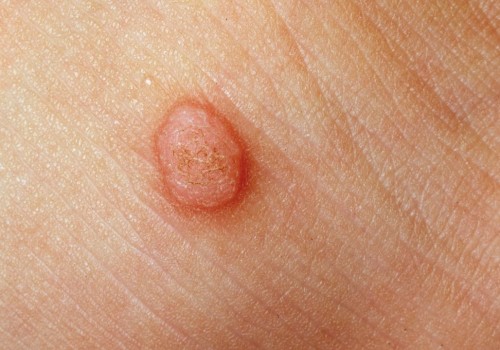 Do Genital Warts Bleed? An Expert's Guide to Understanding and Treating
