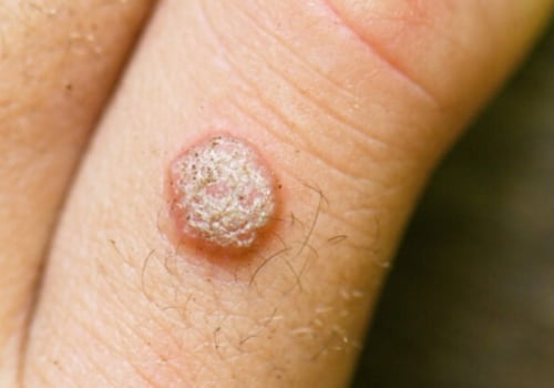 Understanding the Progression of Genital Warts: An Expert's Guide