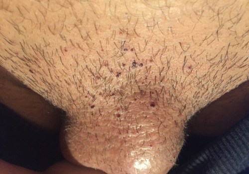 Can Genital Warts Be Black?