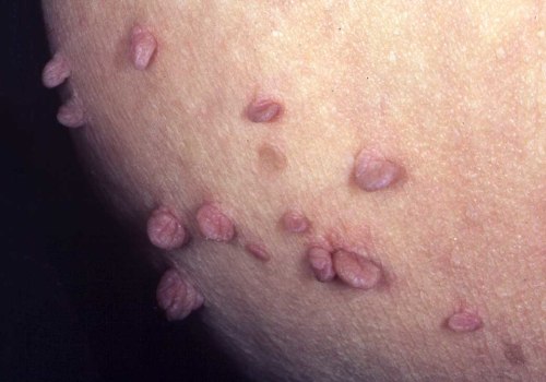 Why Genital Warts Itch and How to Treat Them