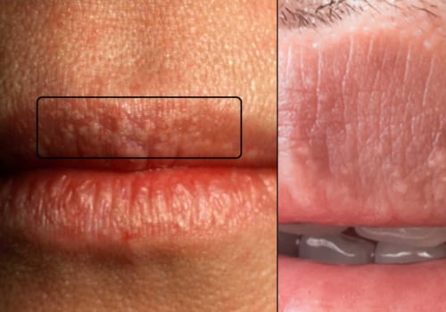 Why Do Genital Warts Turn White? A Comprehensive Guide