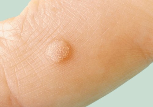 Everything You Need to Know About Genital Warts and HPV