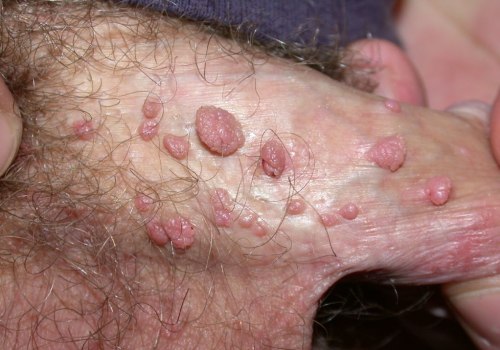 Are Genital Warts a Permanent STD?