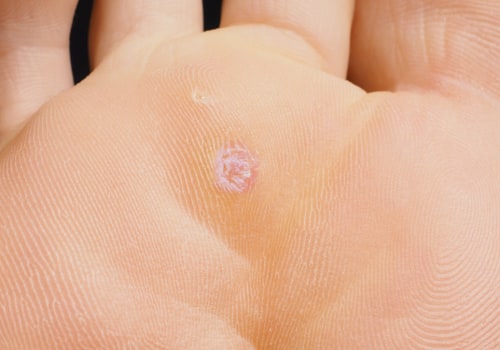 How to Prevent Genital Warts and Where They Can Spread
