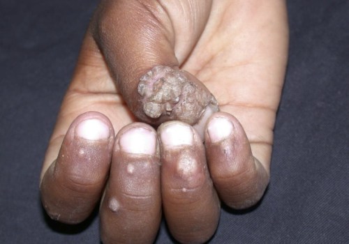 Understanding the Transmission of Genital Warts