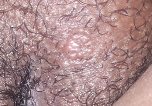 When do Genital Warts Appear? A Comprehensive Guide to HPV and Prevention