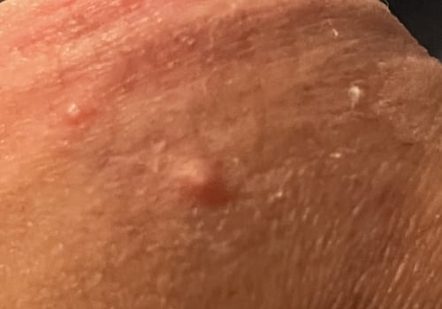 What Are the Signs and Symptoms of Genital Warts?