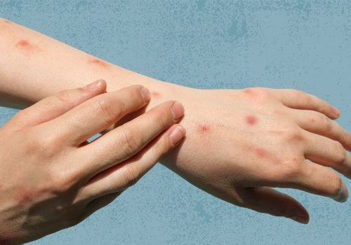 Who Gave Me Genital Warts? Understanding the Causes and Prevention of HPV