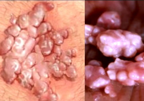 Where Do Genital Warts Appear? - An Expert's Guide
