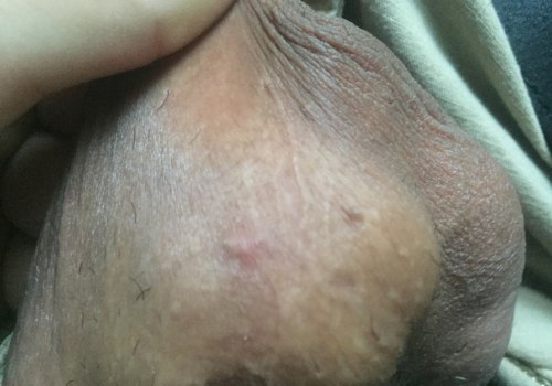 Can I Find Out Who Gave Me Genital Warts? - An Expert's Guide