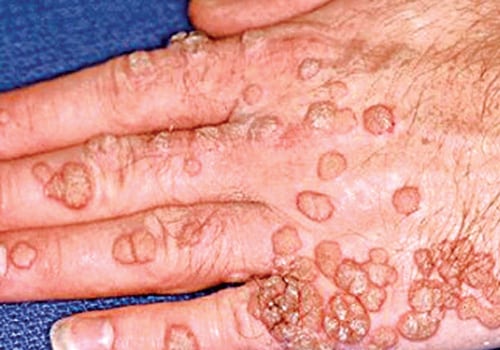 What is the Virus Behind Genital Warts? - An Expert's Perspective